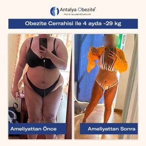 obesity_surgery_before_after__0007_22